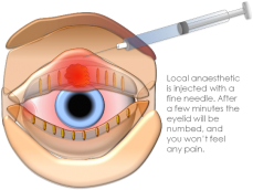 Chalazion Eye Forceps for Microsurgery