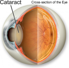 Ophthalmic Procedures: Cataract Surgery Instruments