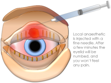 How are Chalazion Eye Forceps Used in Microsurgery?